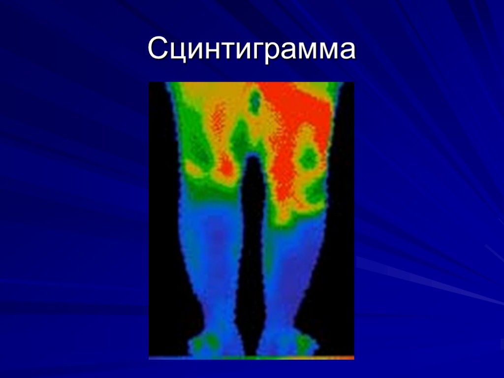 Сцинтиграмма